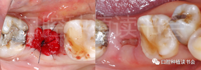 后牙区即刻种植临床指南