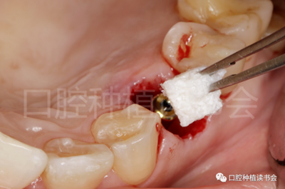 后牙区即刻种植临床指南