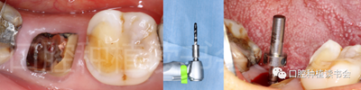 后牙区即刻种植临床指南