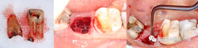 后牙区即刻种植临床指南