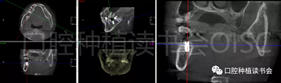 后牙区即刻种植临床指南