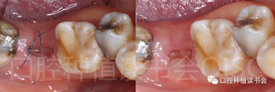 后牙区即刻种植临床指南