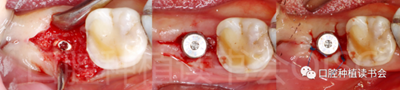 后牙区即刻种植临床指南g