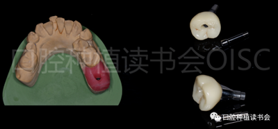 后牙区即刻种植临床指南