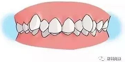 	牙龈萎缩是不治之症？缓解牙龈萎缩5步走！