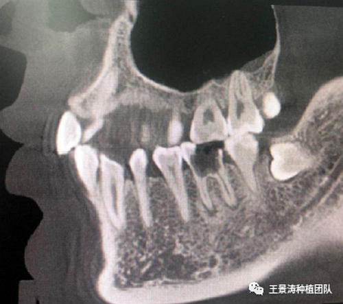 后牙区即刻种植的适应症的思考