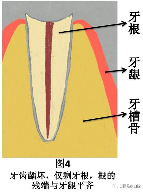 口腔科普 | 残根残冠怎么办——桩核冠