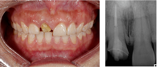 妙手牙医丨残根、残冠还有保留的意义吗？