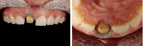 妙手牙医丨残根、残冠还有保留的意义吗？