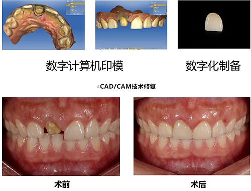 妙手牙医丨残根、残冠还有保留的意义吗？