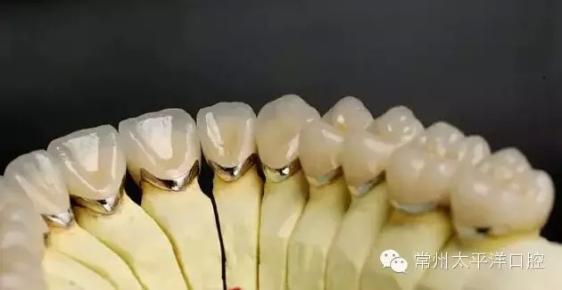 嘉友资讯中心 烤瓷修复 【汇总】各种烤瓷牙的优缺点  优点: 纯钛合金